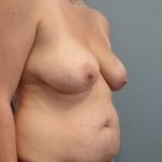 Mommy Makeover Before & After Patient #1982