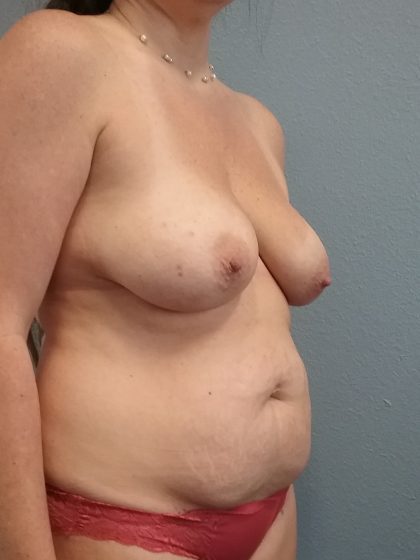 Mommy Makeover Before & After Patient #1982