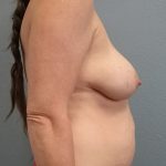 Mommy Makeover Before & After Patient #1982