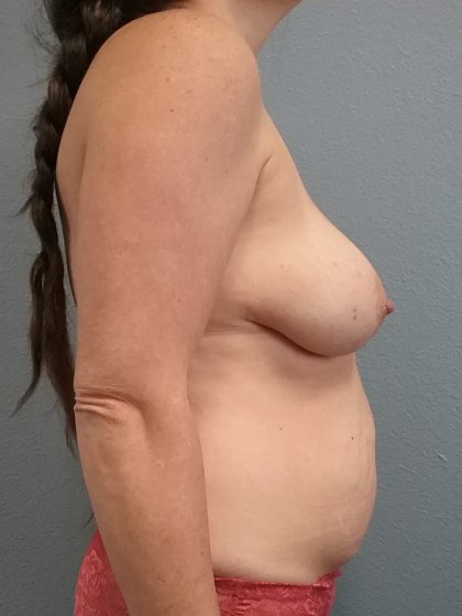 Mommy Makeover Before & After Patient #1982