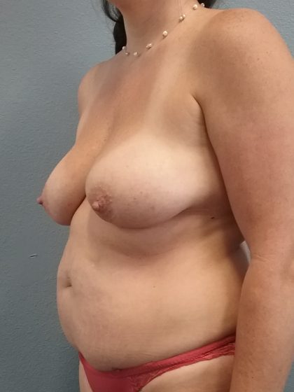 Mommy Makeover Before & After Patient #1982