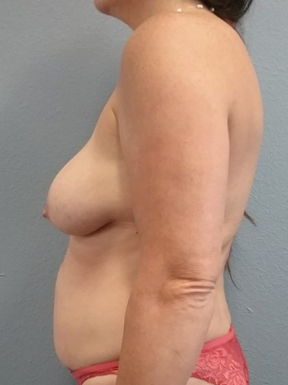 Mommy Makeover Before & After Patient #1982