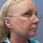 Liposuction of the Neck Before & After Patient #402