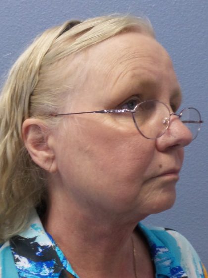 Liposuction of the Neck Before & After Patient #402
