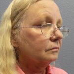 Liposuction of the Neck Before & After Patient #402