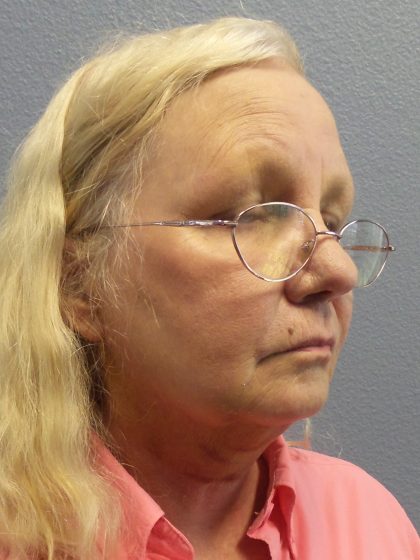 Liposuction of the Neck Before & After Patient #402