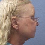 Liposuction of the Neck Before & After Patient #402