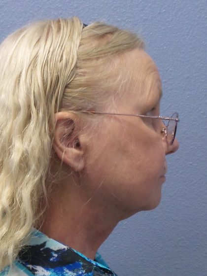 Liposuction of the Neck Before & After Patient #402