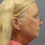 Liposuction of the Neck Before & After Patient #402