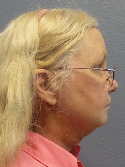 Liposuction of the Neck Before & After Patient #402