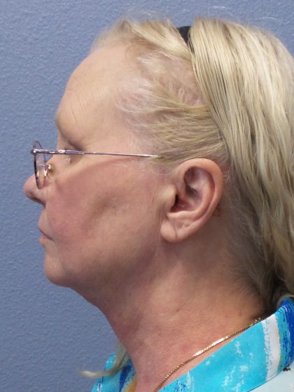 Liposuction of the Neck Before & After Patient #402