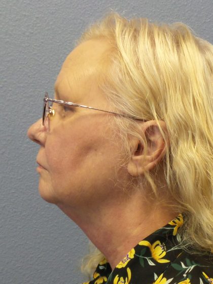 Liposuction of the Neck Before & After Patient #402