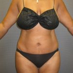Abdominoplasty Before & After Patient #2031