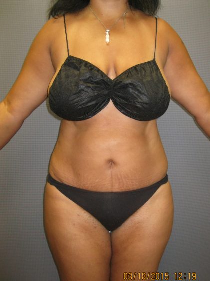 Abdominoplasty Before & After Patient #2031