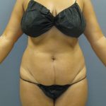 Abdominoplasty Before & After Patient #2031