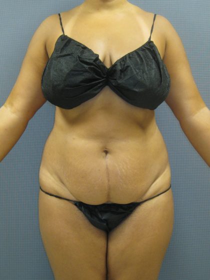 Abdominoplasty Before & After Patient #2031