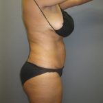 Abdominoplasty Before & After Patient #2031