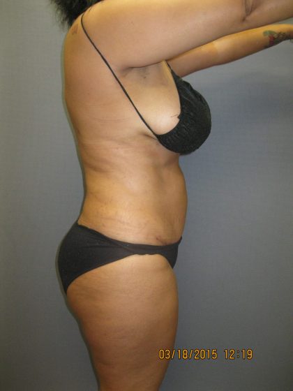 Abdominoplasty Before & After Patient #2031