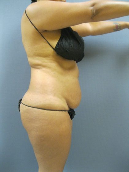 Abdominoplasty Before & After Patient #2031