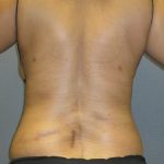 Abdominoplasty Before & After Patient #2031