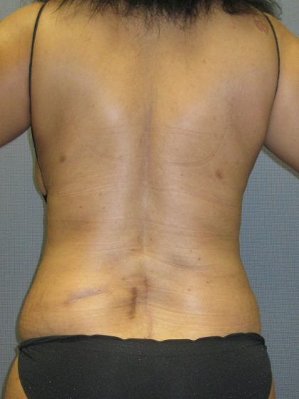 Abdominoplasty Before & After Patient #2031