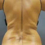 Abdominoplasty Before & After Patient #2031