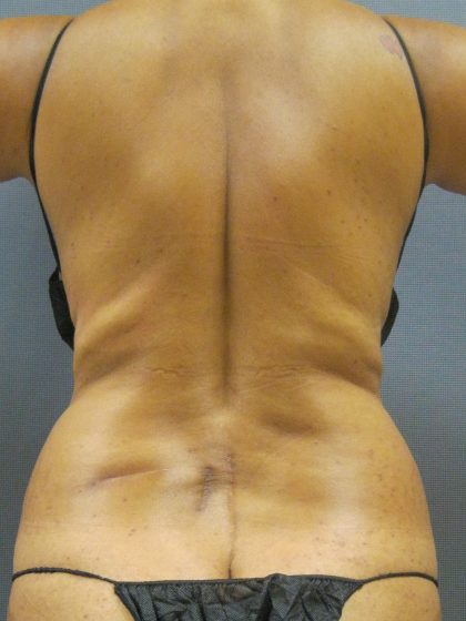 Abdominoplasty Before & After Patient #2031