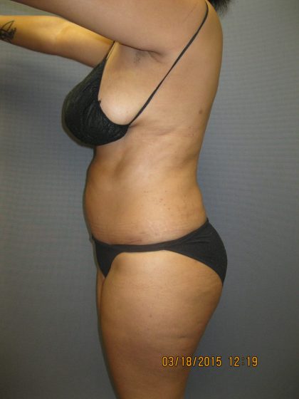 Abdominoplasty Before & After Patient #2031
