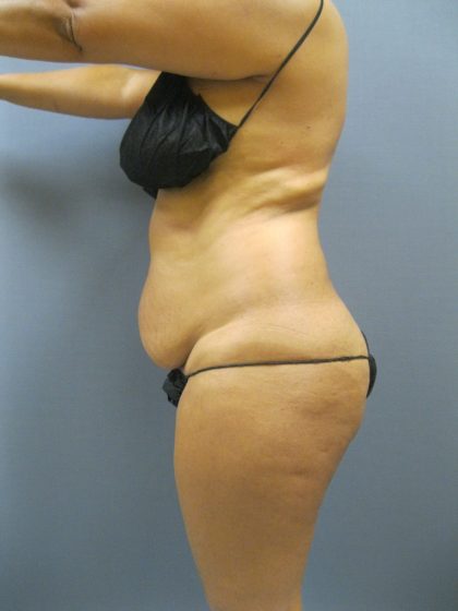 Abdominoplasty Before & After Patient #2031