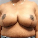 High BMI (Larger Patients) Surgery Before & After Patient #1867