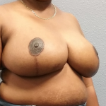 High BMI (Larger Patients) Surgery Before & After Patient #1867