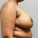 High BMI (Larger Patients) Surgery Before & After Patient #1867