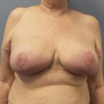 Breast Reduction Before & After Patient #1842