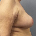 Breast Reduction Before & After Patient #1842