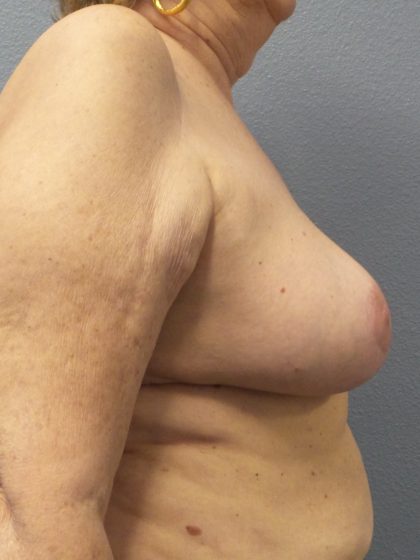 Breast Reduction Before & After Patient #1842
