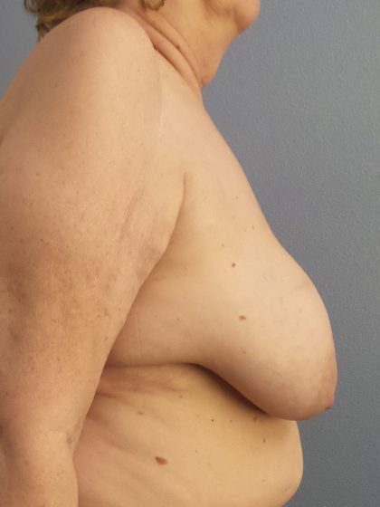 Breast Reduction Before & After Patient #1842