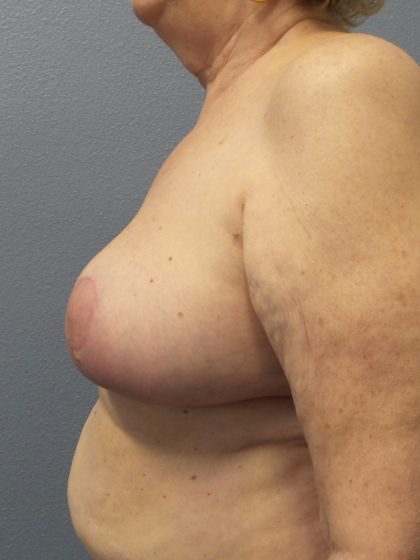 Breast Reduction Before & After Patient #1842