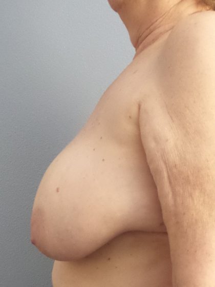 Breast Reduction Before & After Patient #1842