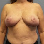Breast Reduction Before & After Patient #1878