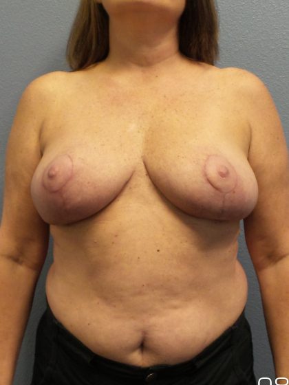 Breast Reduction Before & After Patient #1878