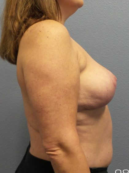 Breast Reduction Before & After Patient #1878