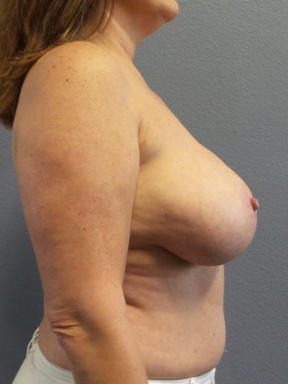 Breast Reduction Before & After Patient #1878