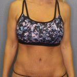 Abdominoplasty Before & After Patient #2080