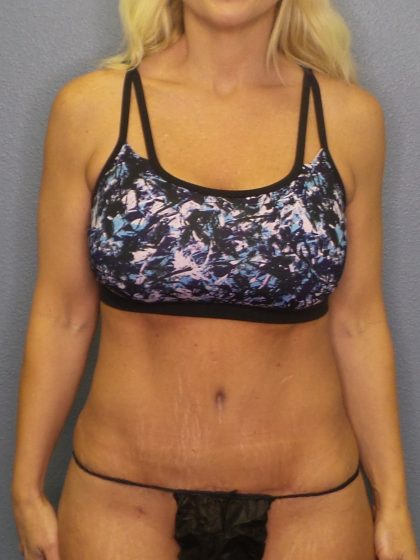 Abdominoplasty Before & After Patient #2080