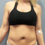 Abdominoplasty Before & After Patient #2080