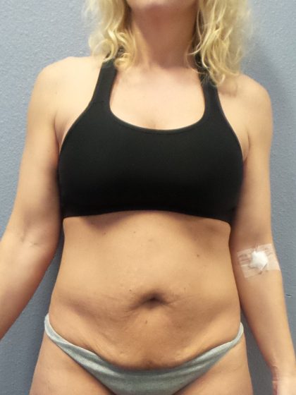 Abdominoplasty Before & After Patient #2080