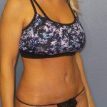 Abdominoplasty Before & After Patient #2080