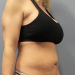Abdominoplasty Before & After Patient #2080