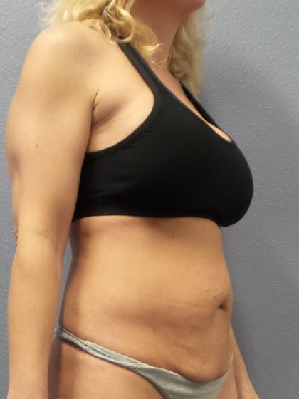 Abdominoplasty Before & After Patient #2080