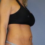 Abdominoplasty Before & After Patient #2080